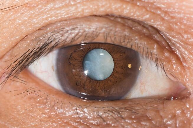 For cataracts, exercises to improve vision are indicated.