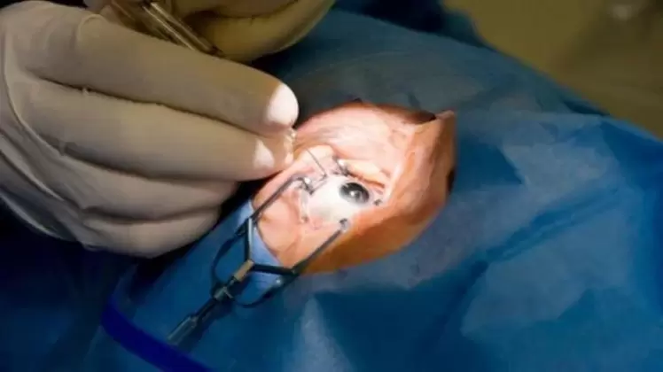 Vitrectomy - removal of the vitreous body from the eye
